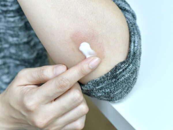 A Guide for Mastering Eczema Treatment Products in Singapore