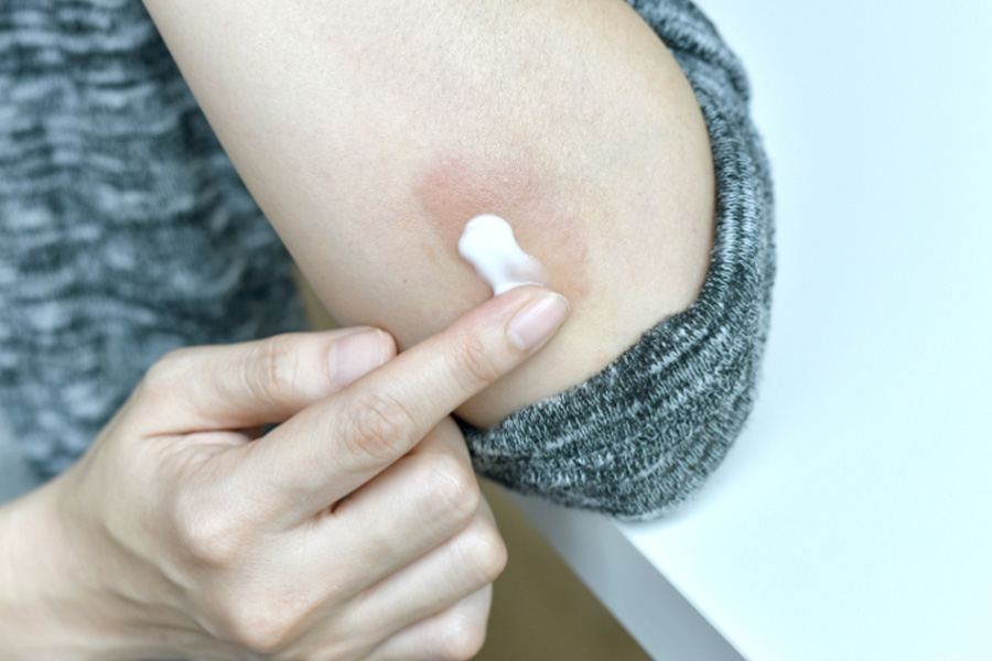 A Guide for Mastering Eczema Treatment Products in Singapore